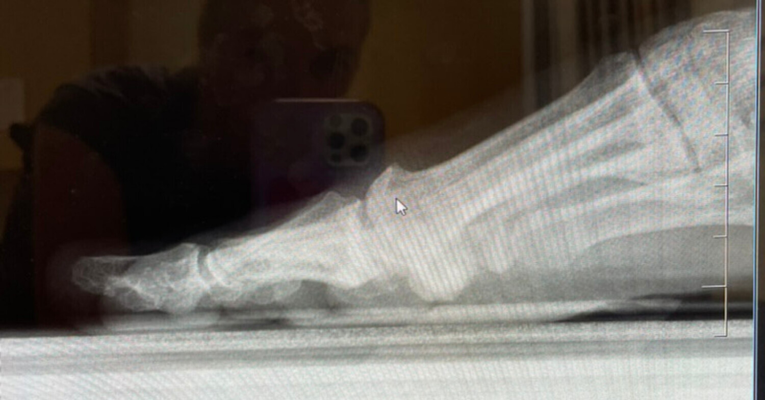 arthritis jointpain OA osteoarthritis foot